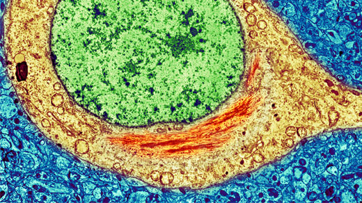 Micrograph of a neuron showing aggregations of tau protein.